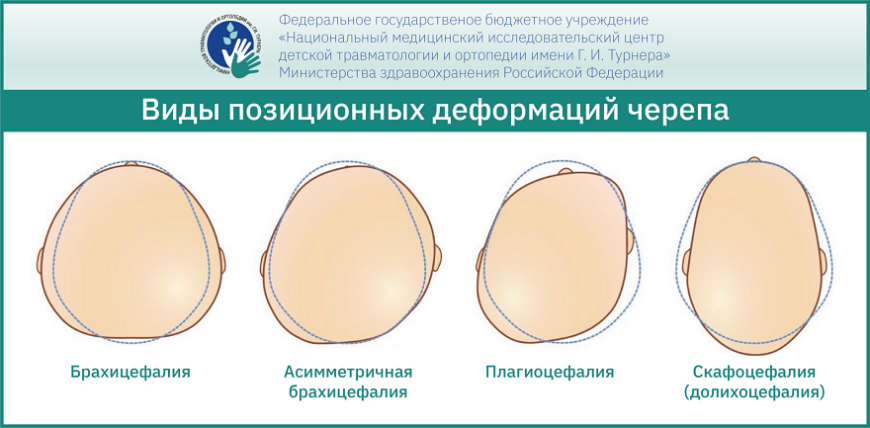 В НМИЦ имени Турнера создали 3D-печатные ортопедические шлемы В НМИЦ имени Турнера создали 3D-печатные ортопедические шлемы
