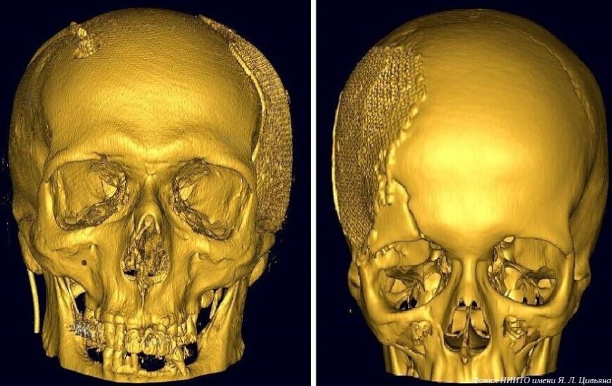 Новосибирские нейрохирурги получили патент на 3D-печатный имплантат