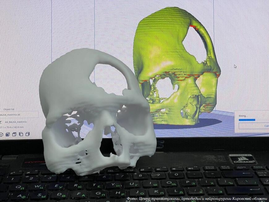 Технологии 3D-моделирования и 3D-печати помогают кировским врачам проводить сложные операции