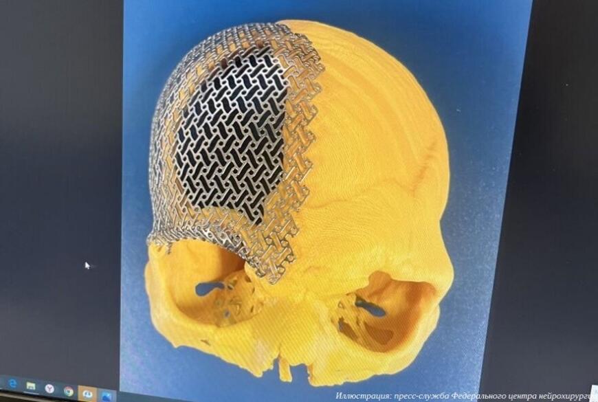 Тюменские хирурги применяют 3D-печать в краниопластике