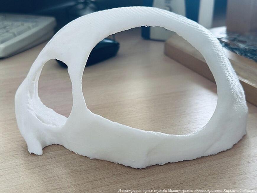 Кировские нейрохирурги провели краниопластику с использованием 3D-моделирования и 3D-печати