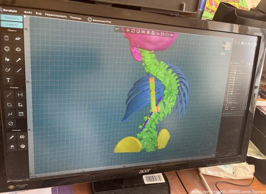 Петербургские врачи применили технологии 3D-печати в операции по исправлению сколиоза