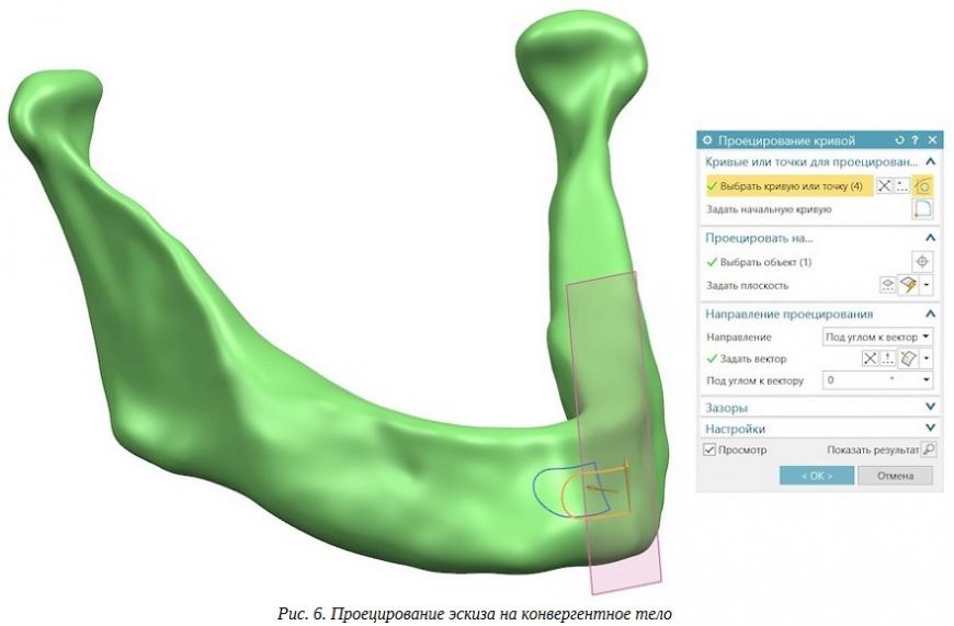 Новое слово в реинжиниринге: создание челюстного имплантата с применением конвергентного моделирования