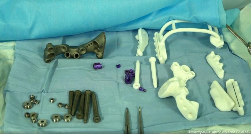 Самарские врачи впервые в России провели протезирование крестца с использованием 3D-печатного имплантата