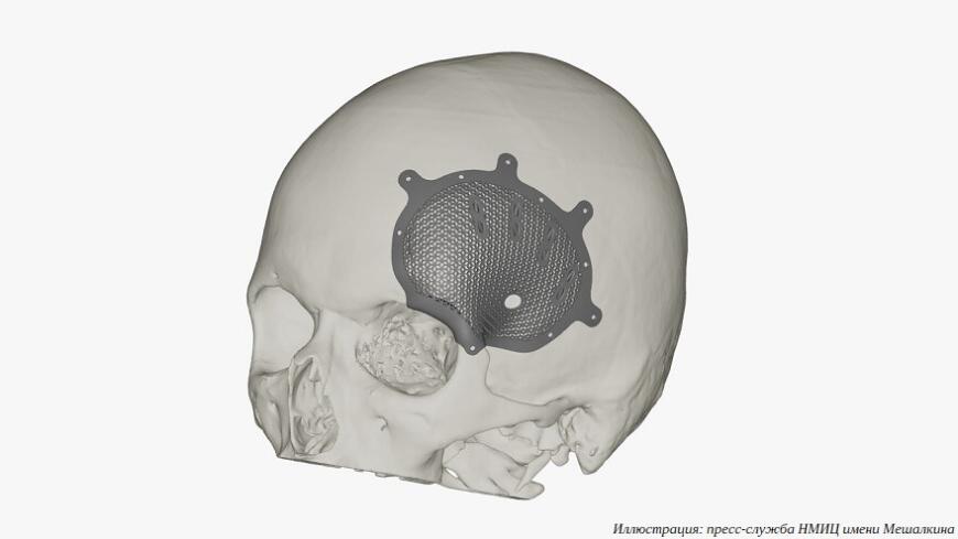 Новосибирские хирурги спасли зрение молодого пациента с помощью 3D-печатного имплантата