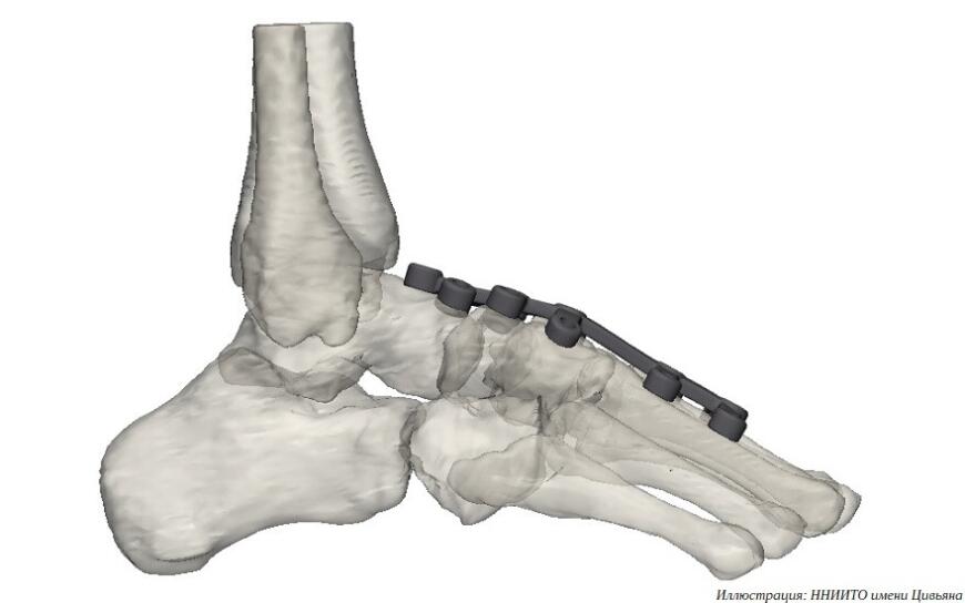 Новосибирские врачи установили 3D-печатный имплантат девочке с тяжелой деформацией стоп