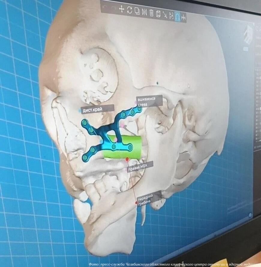 Технологии 3D-печати помогли челябинским врачам провести сложную операцию