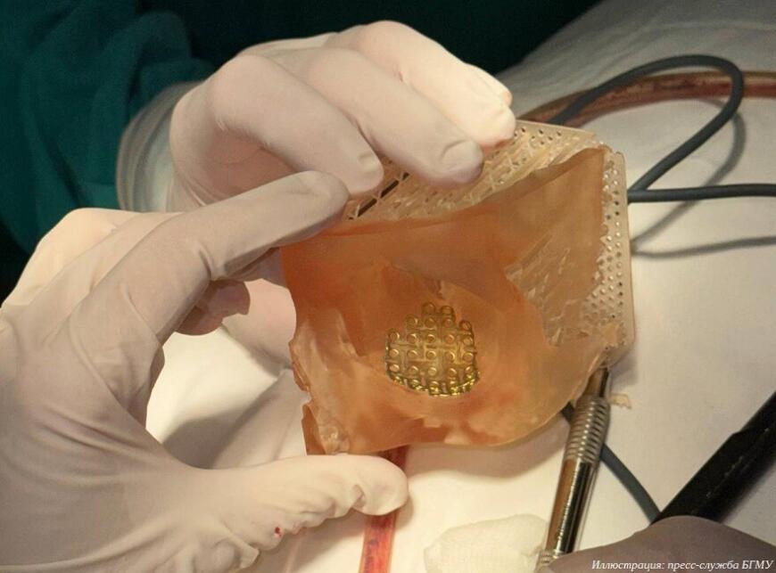 Уфимские врачи применяют технологии 3D-печати в челюстно-лицевой хирургии Уфимские врачи применяют технологии 3D-печати в челюстно-лицевой хирургии