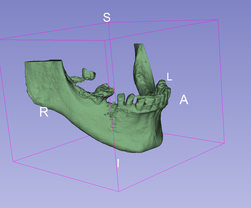 Сегментирование костей из DICOM срезов в 3D slicer