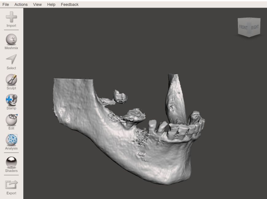 Сегментирование костей из DICOM срезов в 3D slicer
