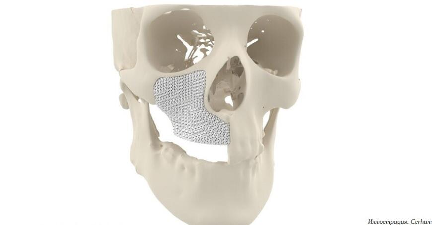 Европейским хирургам доступны новые 3D-печатные костные имплантаты MyBone