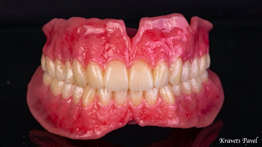 Съемное протезирование в стоматологии