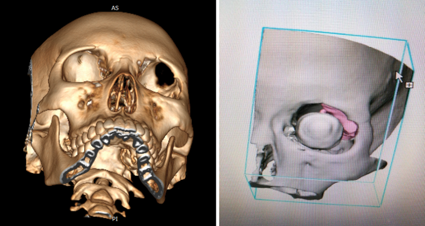 Технологии 3D-печати помогли петербургским нейрохирургам провести сложную операцию