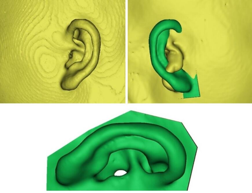 3D-сканирование в лечении микротии