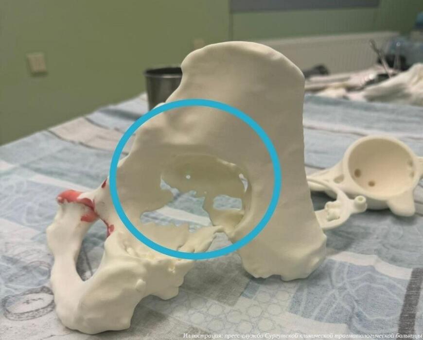 Сургутские врачи впервые в своей практике установили 3D-печатный эндопротез