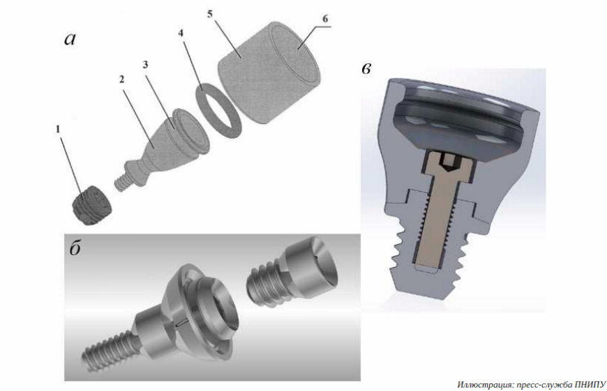 Новая конструкция слуховых имплантатов с 3D-печатными переходниками минимизирует потерю звука Новая конструкция слуховых имплантатов с 3D-печатными переходниками минимизирует потерю звука