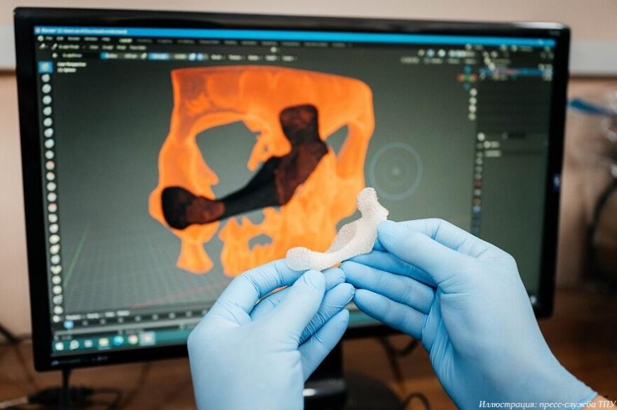Томские хирурги применяют 3D-печатные полимерные имплантаты