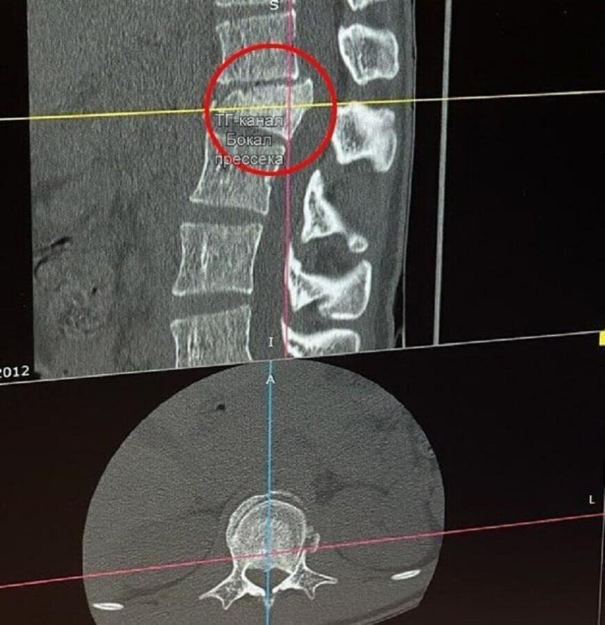 3D-технологии помогли прооперировать пациента с травмой позвоночника