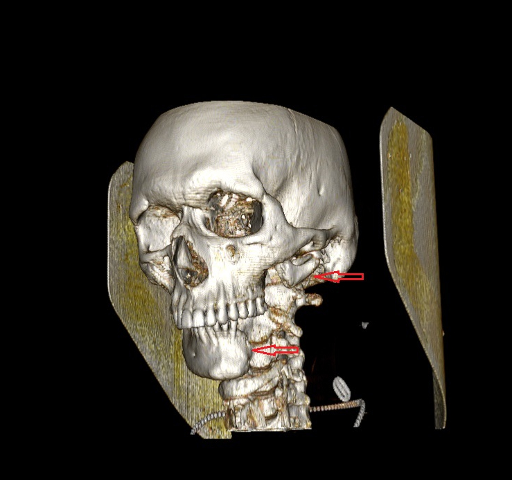Предоперационное планирование по травматологии/имплантации
