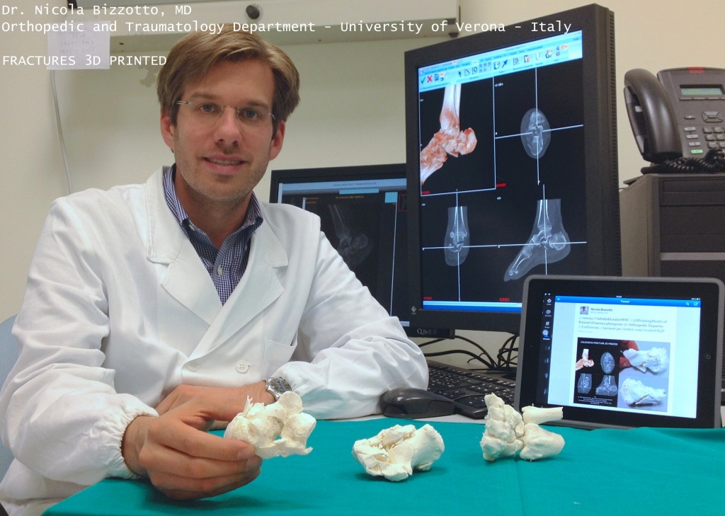 Доктор Биззотто и копии сломанных костей, напечатанные на 3D-принтере